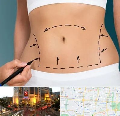 عمل ابدومینوپلاستی در جنت آباد تهران