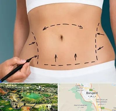 عمل ابدومینوپلاستی در بروجرد