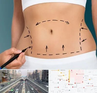 عمل ابدومینوپلاستی در توحید