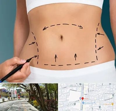 عمل ابدومینوپلاستی در خیابان توحید اصفهان