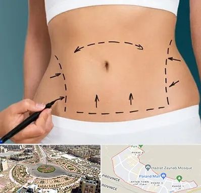 عمل ابدومینوپلاستی در پرند