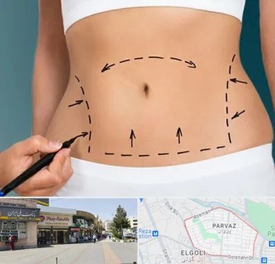 عمل ابدومینوپلاستی در پرواز تبریز