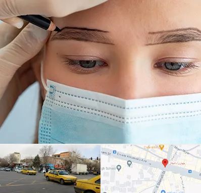 کاشت ابرو در شهناز تبریز