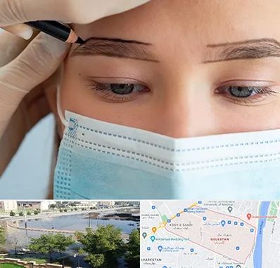 کاشت ابرو در گلستان اهواز 