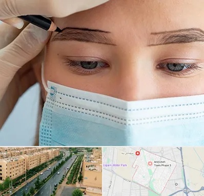 کاشت ابرو در فاز سه اندیشه