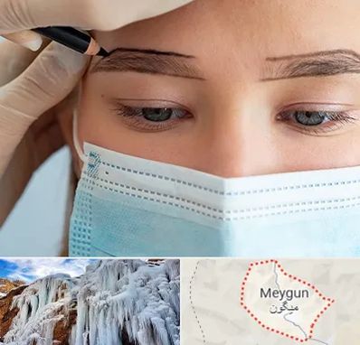 کاشت ابرو در میگون