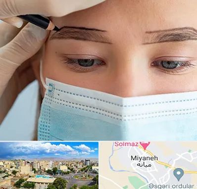 کاشت ابرو در میانه