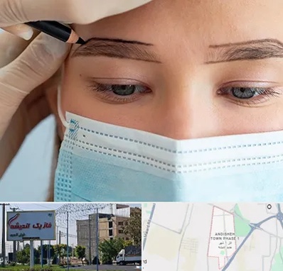 کاشت ابرو در فاز یک اندیشه