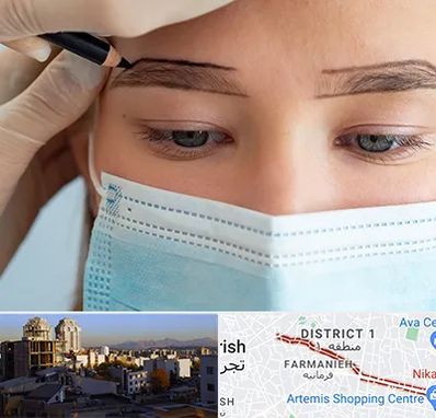 کاشت ابرو در فرمانیه 