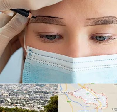 کاشت ابرو در یاسوج
