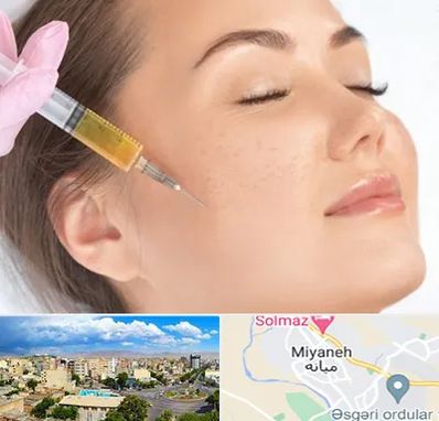 آموزش تزریق ژل و بوتاکس در میانه