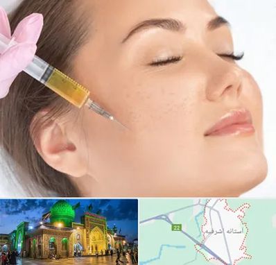 آموزش تزریق ژل و بوتاکس در آستانه اشرفیه