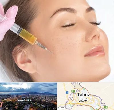 آموزش تزریق ژل و بوتاکس در تبریز