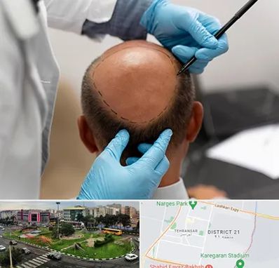 آموزش کاشت مو در تهرانسر 