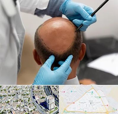 آموزش کاشت مو در قاسم آباد مشهد 