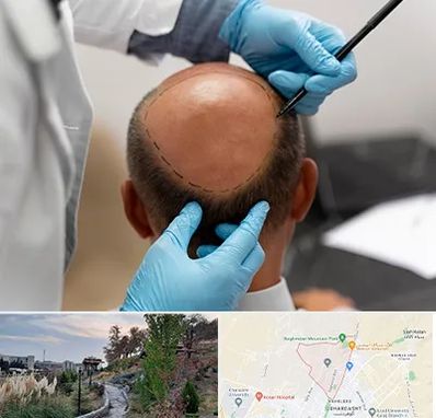 آموزش کاشت مو در باغستان کرج 