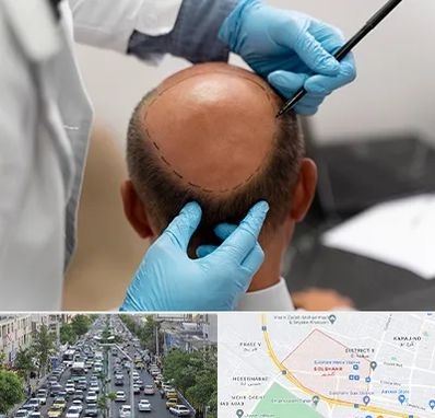 آموزش کاشت مو در گلشهر کرج 