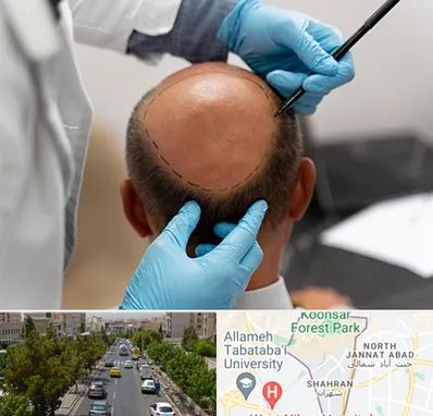 آموزش کاشت مو در شهران 