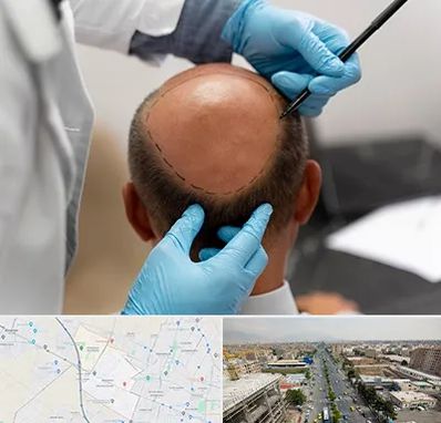 آموزش کاشت مو در حصارک کرج 