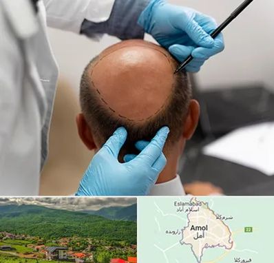 آموزش کاشت مو در آمل