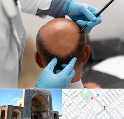 آموزش کاشت مو در مصلی مشهد