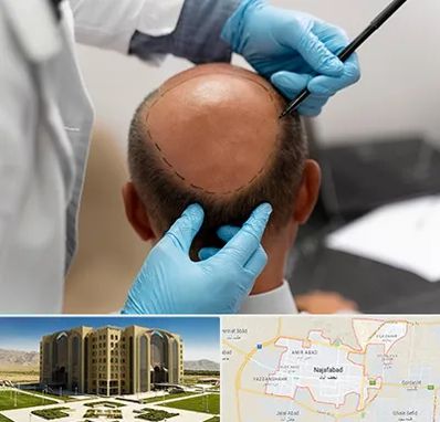 آموزش کاشت مو در نجف آباد