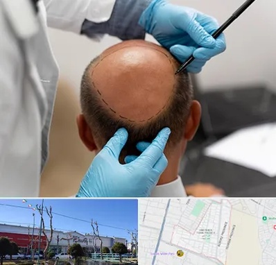 آموزش کاشت مو در فاز دو اندیشه