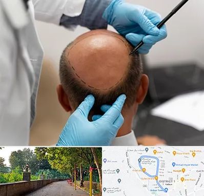 آموزش کاشت مو در فلکه گاز رشت 