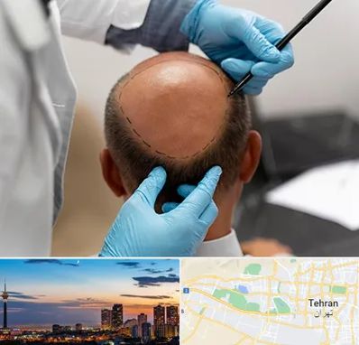 آموزش کاشت مو در غرب تهران 