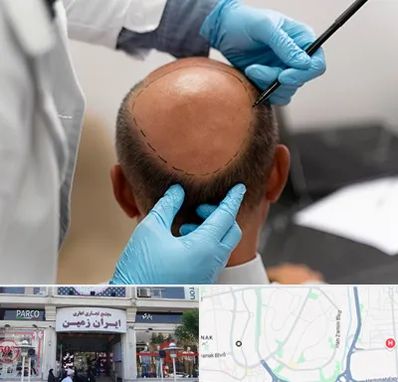 آموزش کاشت مو در ایران زمین