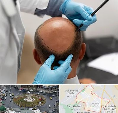 آموزش کاشت مو در فردیس کرج 