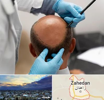 آموزش کاشت مو در زاهدان