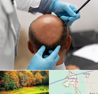 آموزش کاشت مو در کردکوی