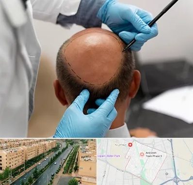 آموزش کاشت مو در فاز سه اندیشه