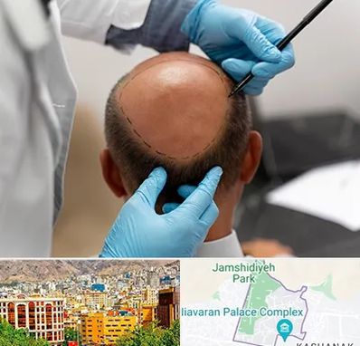 آموزش کاشت مو در نیاوران 