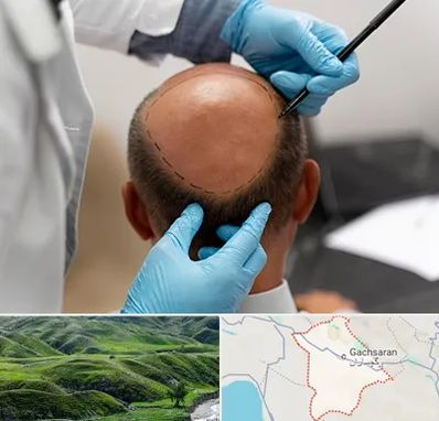 آموزش کاشت مو در گچساران