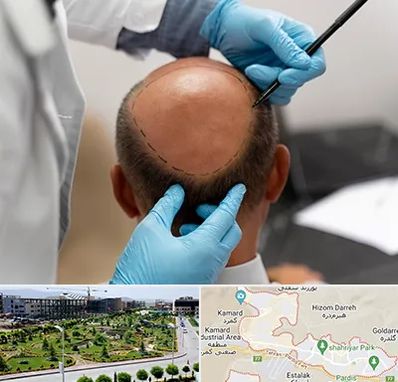 آموزش کاشت مو در پردیس