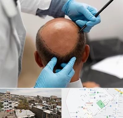 آموزش کاشت مو در شمیران نو 