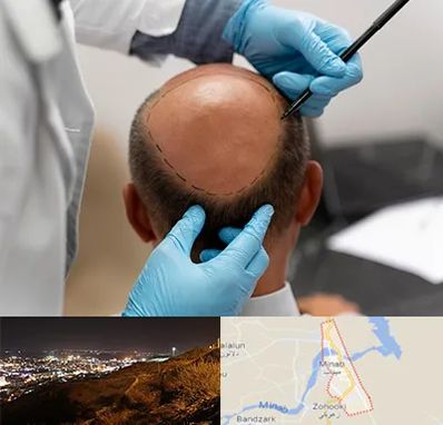آموزش کاشت مو در میناب