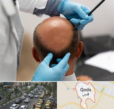 آموزش کاشت مو در شهر قدس