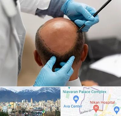 آموزش کاشت مو در آجودانیه 