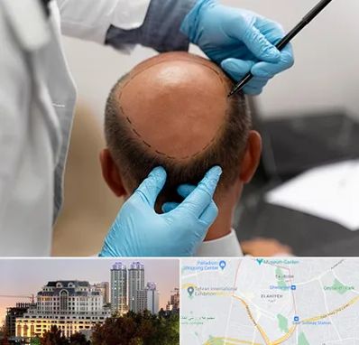 آموزش کاشت مو در فرشته 