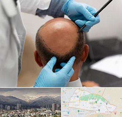 آموزش کاشت مو در منطقه 4 تهران