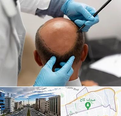 آموزش کاشت مو در سعادت آباد 