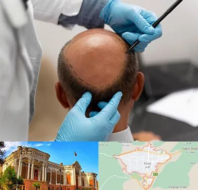 آموزش کاشت مو در خوی