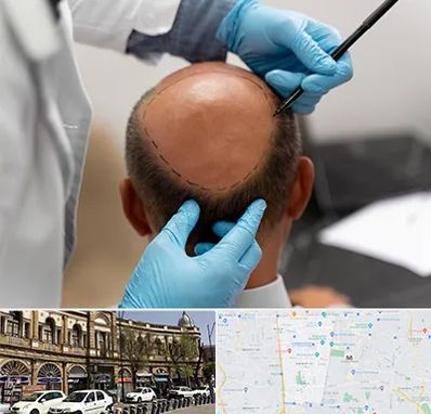 آموزش کاشت مو در منطقه 11 تهران