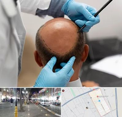 آموزش کاشت مو در باغ فیض اسلامشهر