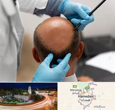 آموزش کاشت مو در همدان