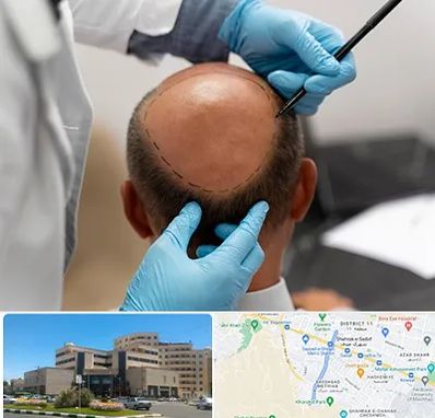 آموزش کاشت مو در صیاد شیرازی مشهد 