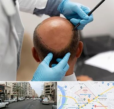 آموزش کاشت مو در زیتون کارمندی اهواز 